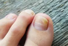 Zblízka viditelný žlutavý nehet na noze s příznaky plísně.